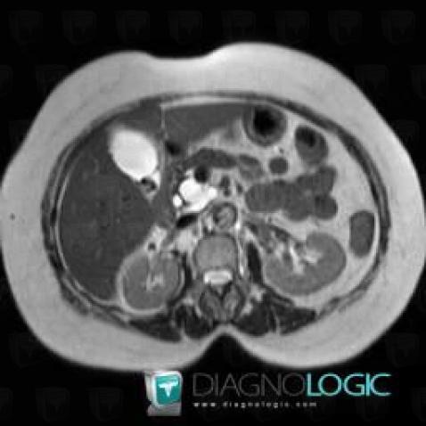 Intraductal papillary mucinous tumor-pancreas, Pancreas, MRI