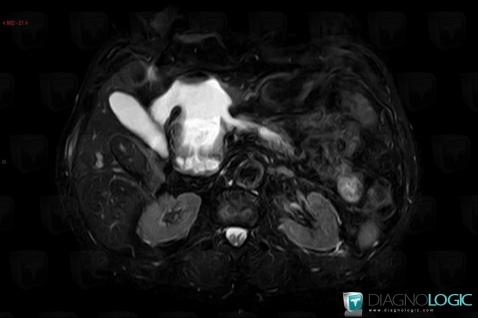 Intraductal papillary mucinous tumor-pancreas, Pancreas, MRI