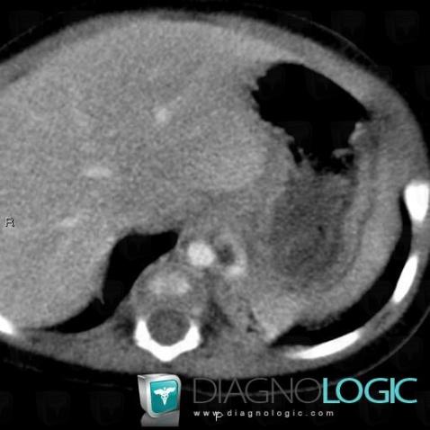 Intralobar sequestration, Aorta, CT