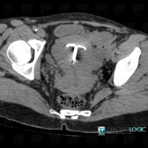 Intrauterine device, Uterus, CT