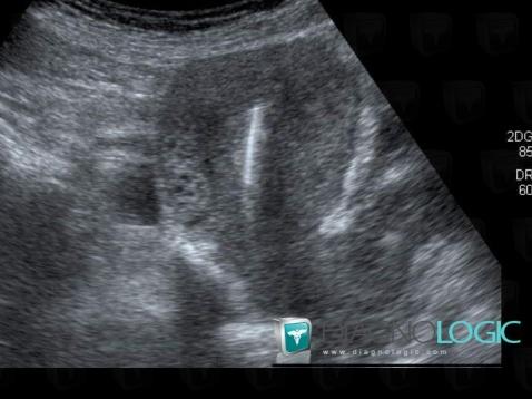 Intrauterine device, Uterus, US