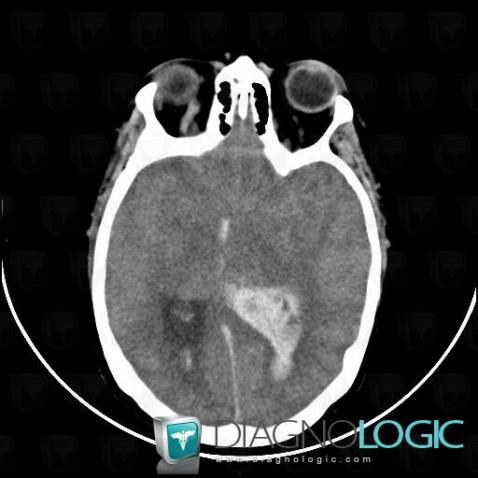 Intraventricular hemorrhage, Ventricles / Periventricular region, CT