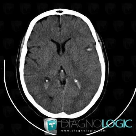 Intraventricular hemorrhage, Ventricles / Periventricular region, CT