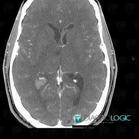 Intraventricular hemorrhage, Ventricles / Periventricular region, CT