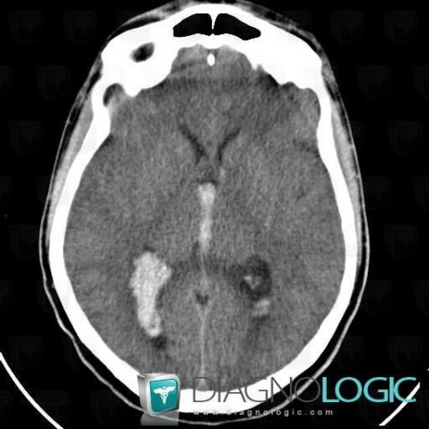 Intraventricular hemorrhage, Ventricles / Periventricular region, CT