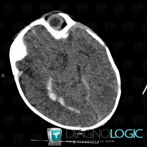 Intraventricular hemorrhage, Ventricles / Periventricular region, CT