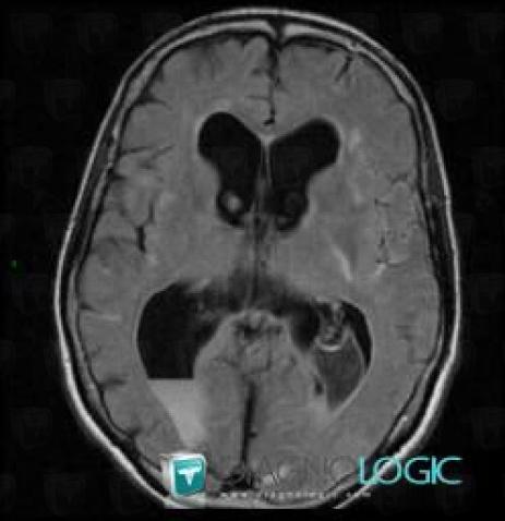 Intraventricular hemorrhage, Ventricles / Periventricular region, MRI