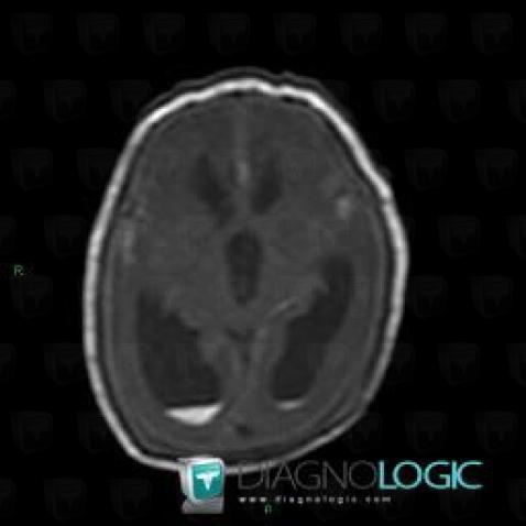 Intraventricular hemorrhage, Ventricles / Periventricular region, MRI