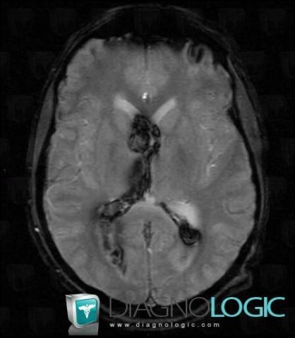 Intraventricular hemorrhage, Ventricles / Periventricular region, MRI