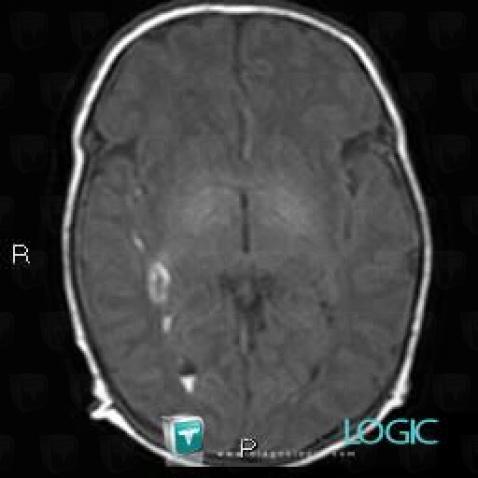 Intraventricular hemorrhage, Ventricles / Periventricular region, MRI