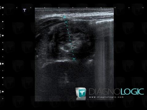 Radiology case : Intussusception (US ,X rays) - Diagnologic