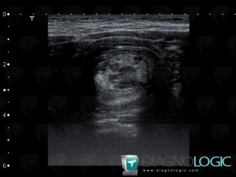 Intussusception, Colon, US