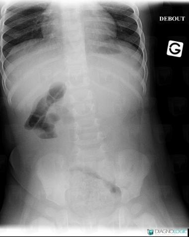 Intussusception, Colon, X rays