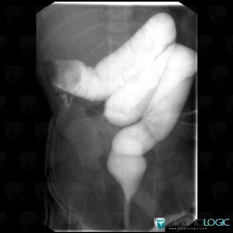 Intussusception, Colon, X rays