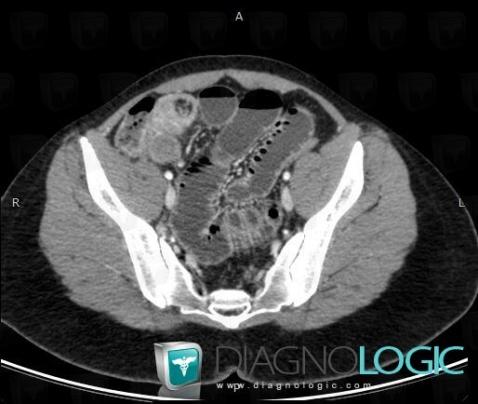 Intussusception, Small bowel, CT