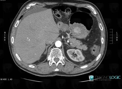 Intussusception, Stomach, CT