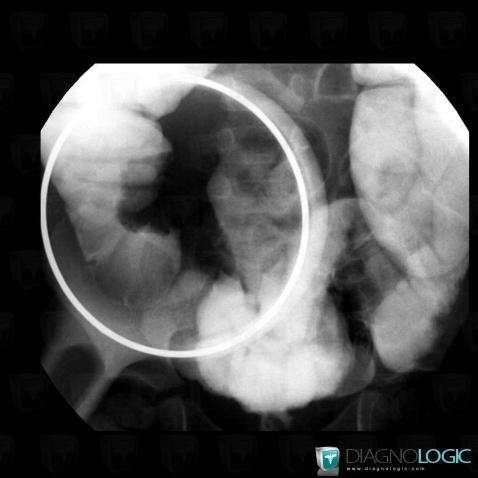 Invagination intestinale, Caecum / Appendice, Colon, Radio