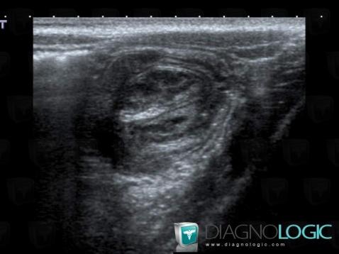 Invagination intestinale, Caecum / Appendice, Echographie