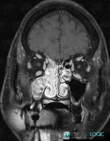Inverting papilloma, Nasal cavity / Nasopharynx, MRI