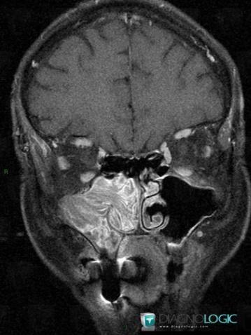 Inverting papilloma, Nasal cavity / Nasopharynx, Sinus, MRI