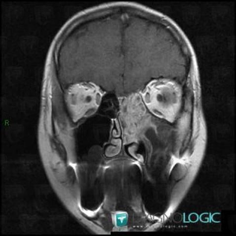 Inverting papilloma, Sinus, MRI