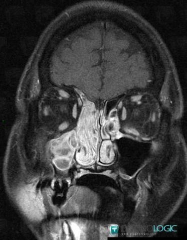 Inverting papilloma, Sinus, MRI
