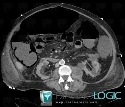 Ischemic colitis, Colon, CT