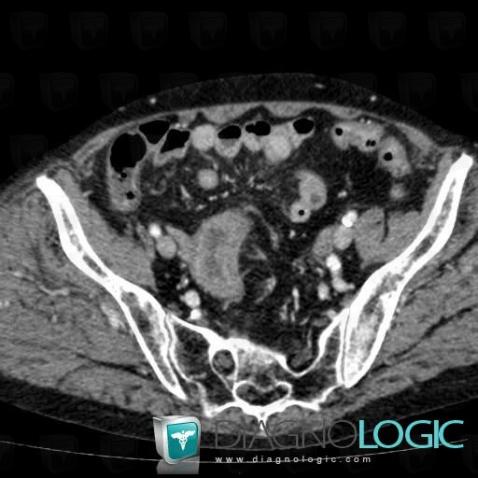 Ischemic colitis, Colon, CT