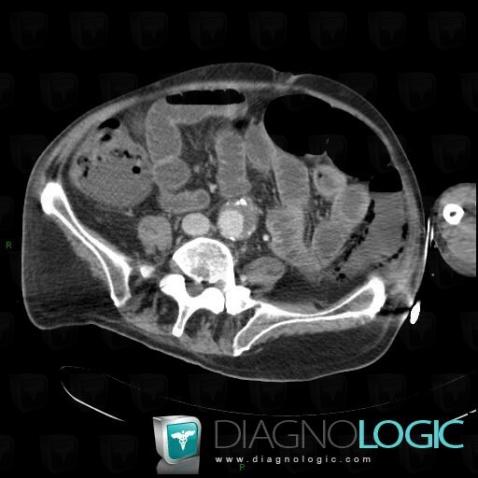 Ischemic colitis, Colon, CT