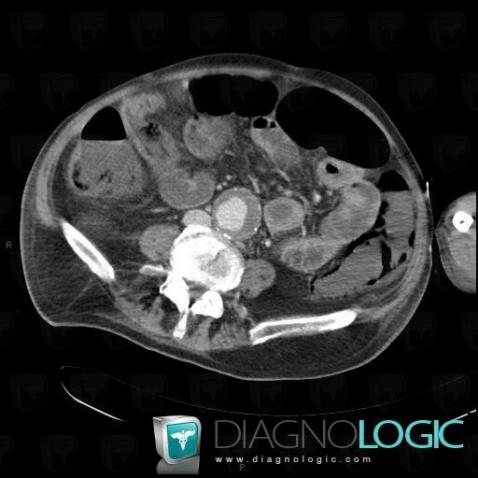 Ischemic colitis, Colon, CT