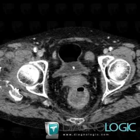 Ischemic colitis, Rectum, CT