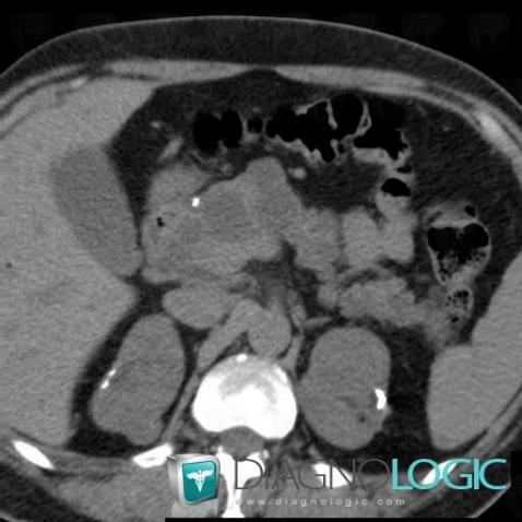 Islet cell tumor, Pancreas, CT