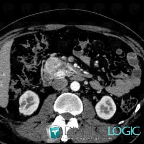 Islet cell tumor, Pancreas, CT