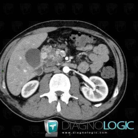 Islet cell tumor, Pancreas, CT