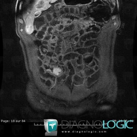 Islet cell tumor, Small bowel, MRI