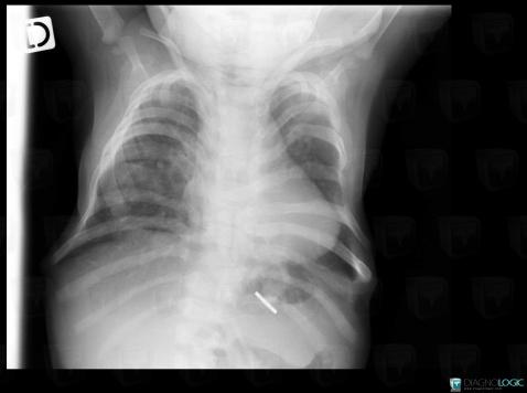 Jarcho-Levin syndrome, Ribs, Vertebral body / Disk, X rays