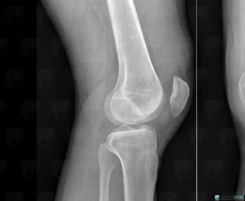 Joint effusion, Patellofemoral joint, X rays