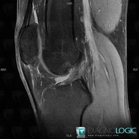 Jumper's knee, Patellar tendon, MRI