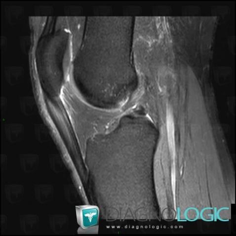 Jumper's knee, Patellar tendon, MRI