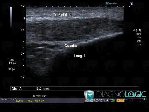 Jumper's knee, Patellar tendon, US