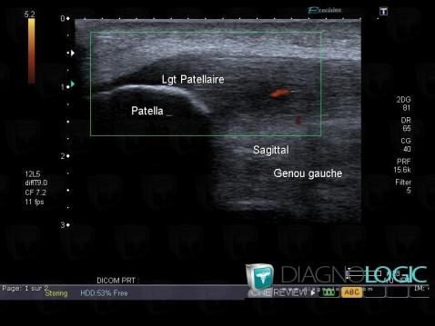 Jumper's knee, Patellar tendon, US