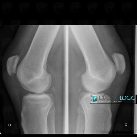 Jumper's knee, Patellar tendon, X rays