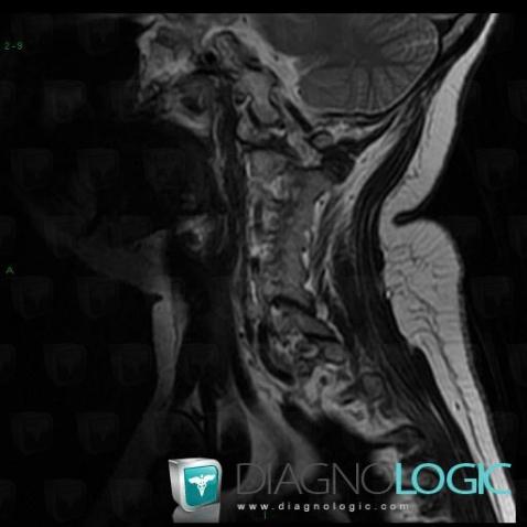 Juvenile rheumatoid arthritis, Vertebral body / Disk, MRI