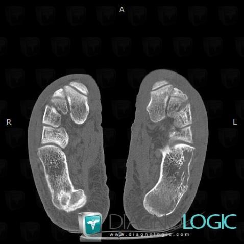 Kaposi sarcoma, Calcaneus, CT