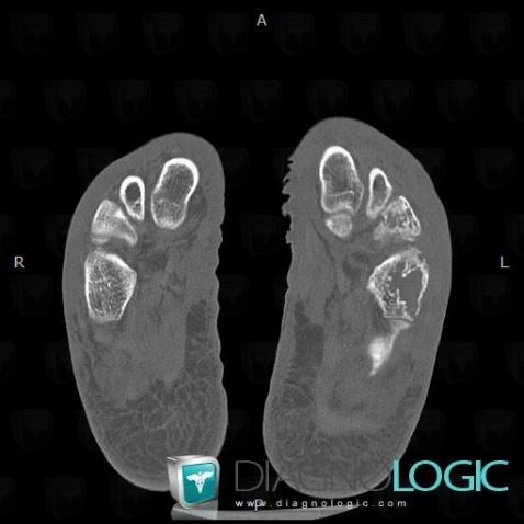 Kaposi sarcoma, Cuboid, CT