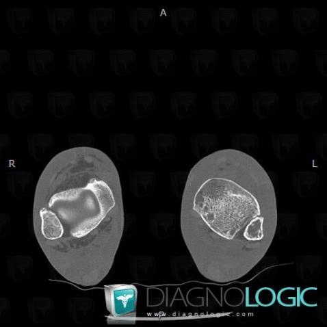 Kaposi sarcoma, Fibula - Distal part, CT