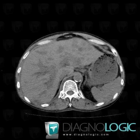 Kaposi sarcoma, Liver, CT