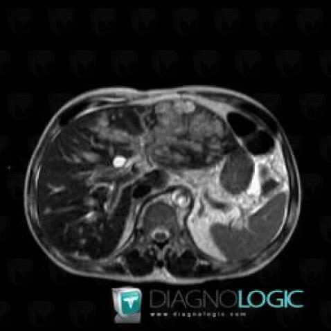 Kaposi sarcoma, Liver, MRI