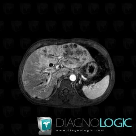 Kaposi sarcoma, Liver, MRI