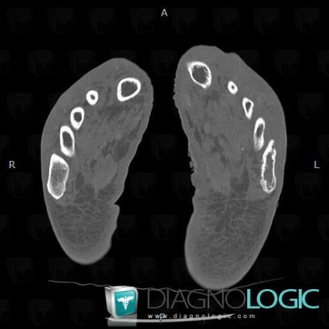 Kaposi sarcoma, Metatarsal bones, CT